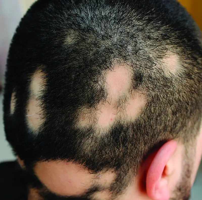alopecia treatmemt