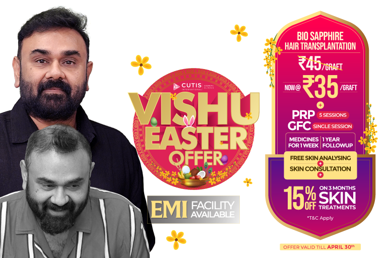 Vishu Easter offer Bio Sapphire hair transplantation at Cutis International Cosmetic Clinics now ₹35 per graft including PRP 5 sessions GFC single session medicines for 1 week 1 year follow up free skin analysing and free skin consultation with 15 percent off on 3 months skin treatments offer valid till April 30