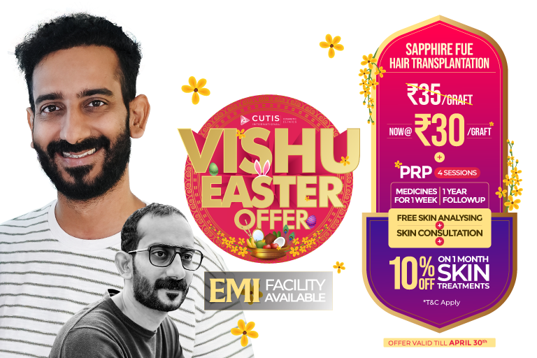Vishu Easter Special Sapphire hair transplantation offer at Cutis International Cosmetic Clinics now ₹30 per graft including PRP 4 sessions medicines for 1 week 1 year follow up free skin analysing and consultation and 10 percent off on 1 month skin treatments valid till April 30