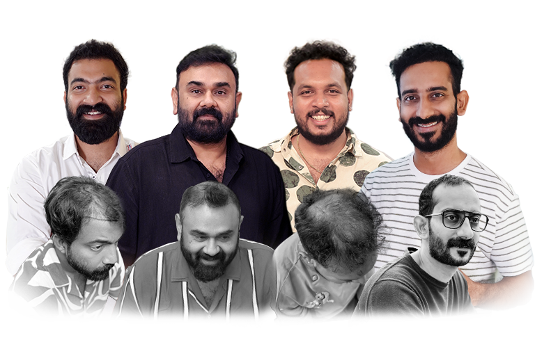 Celebrity hair transplant before and after results at Cutis International hair clinic Kerala Bangalore and GCC showing natural hairline restoration